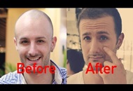 How to Deal with Scalp Itch after a Hair Transplant