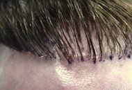 Comparison between Today’s Hair Transplants and Hair Plugs