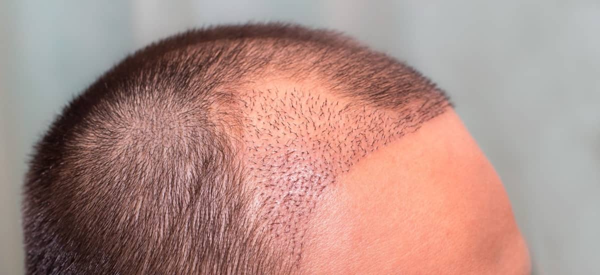 Scar Repair in Turkey