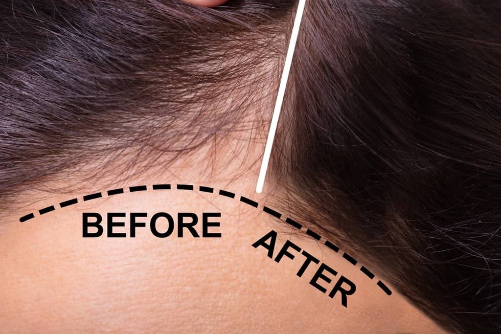 Hair Loss Treatments in Turkey